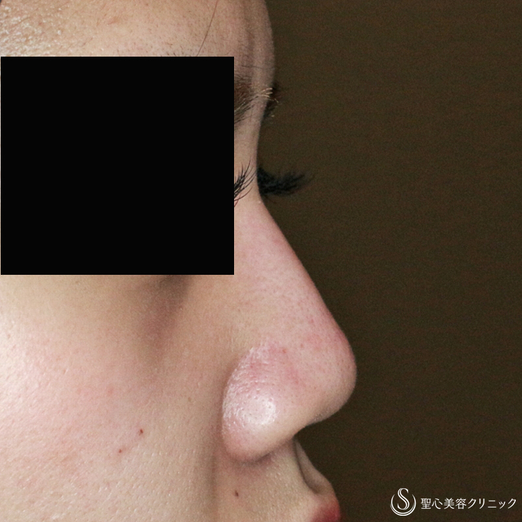 代女性 長期持続型ヒアルロン酸で鼻筋を通す クレヴィエル コントア 処置直後 症例写真 美容整形 美容外科なら聖心美容クリニック 代女性 長期持続型ヒアルロン酸で鼻筋を通す クレヴィエル コントア 処置直後 症例写真 美容整形 美容外科なら聖心美容クリニック
