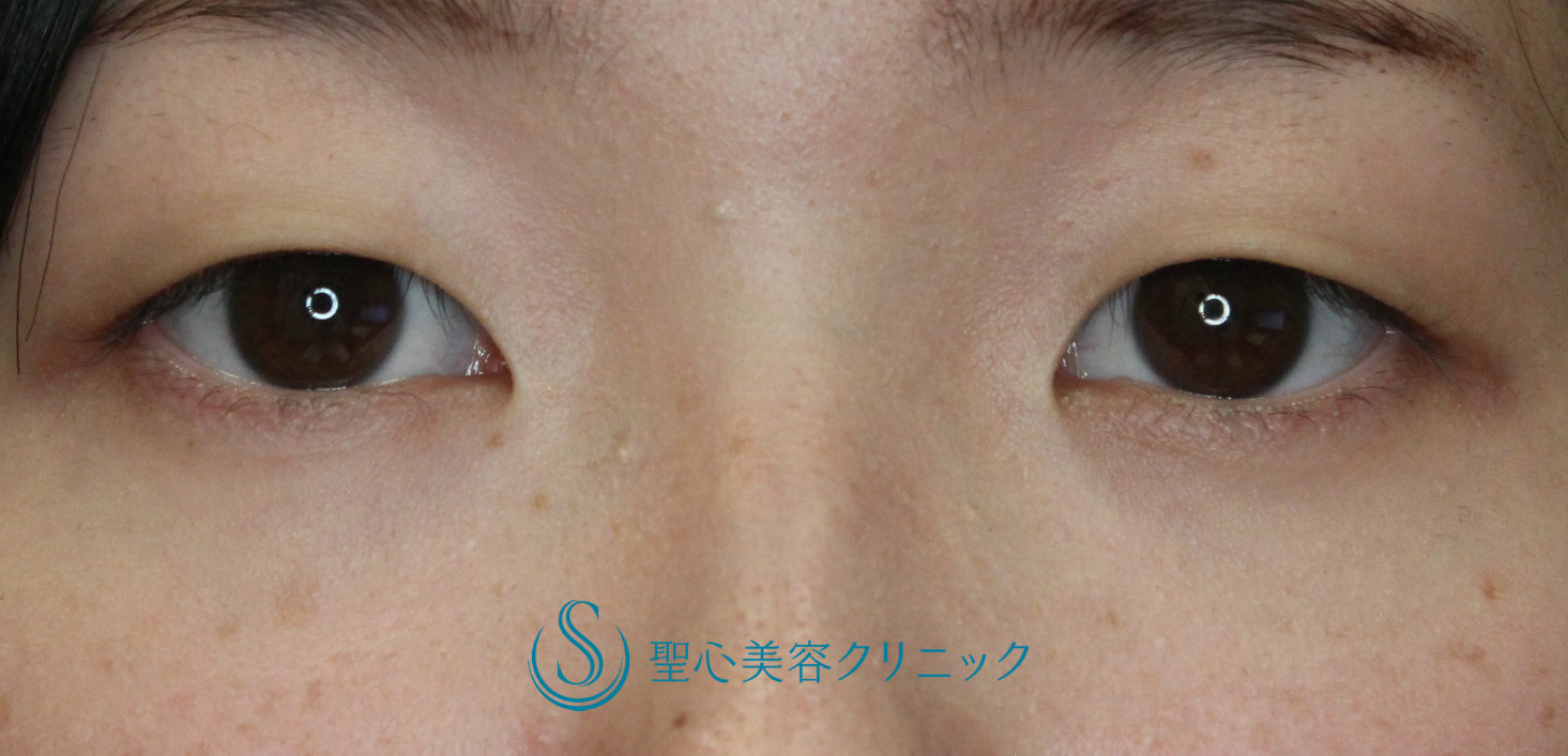 【10代女性・腫れにくい二重術】マイクロメソッド＋α（術直後） Before 