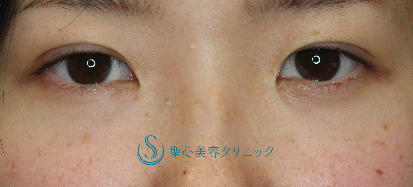 【10代女性・腫れにくい二重術】マイクロメソッド＋α（術直後） After 