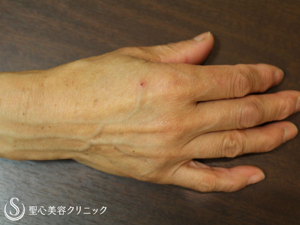 60代女性 手のシミ Qスイッチyagレーザー 1年3ヶ月後 症例写真 美容整形 美容外科なら聖心美容クリニック 60代女性 手のシミ Qスイッチyagレーザー 1年3ヶ月後 症例写真 美容整形 美容外科なら聖心美容クリニック