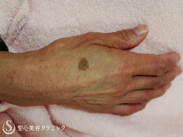 60代女性 手のシミ Qスイッチyagレーザー 1年3ヶ月後 症例写真 美容整形 美容外科なら聖心美容クリニック 60代女性 手のシミ Qスイッチyagレーザー 1年3ヶ月後 症例写真 美容整形 美容外科なら聖心美容クリニック