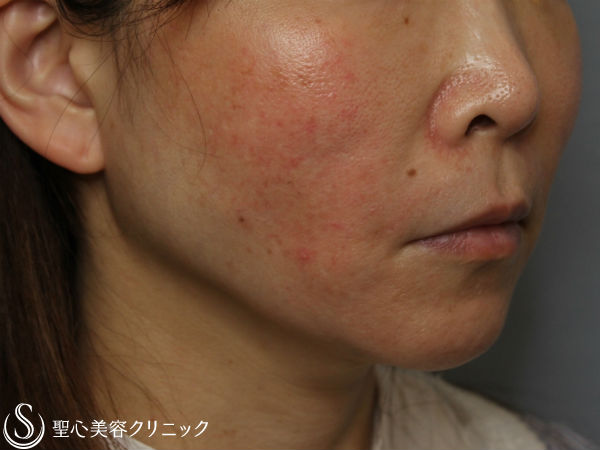 【50代女性・頬のたるみ】スプリングスレッドリフト After 