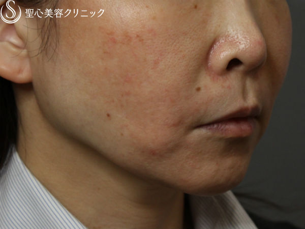 【50代女性・頬のたるみ】スプリングスレッドリフト Before 