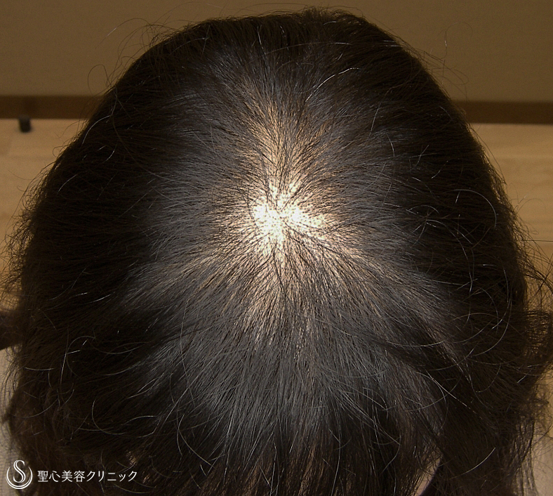 【40代女性・びまん性脱毛】グロースファクター毛髪再生療法 ...