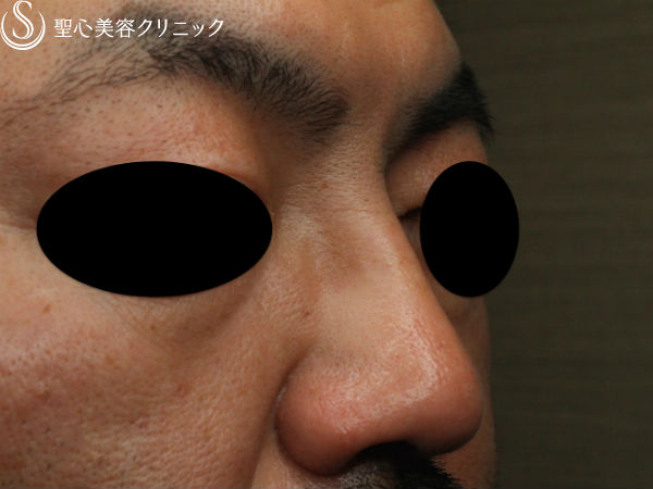 【40代男性・最新の長期持続型ヒアルロン酸で鼻根部を高く】クレヴィエル・コントア（注入直後） Before 