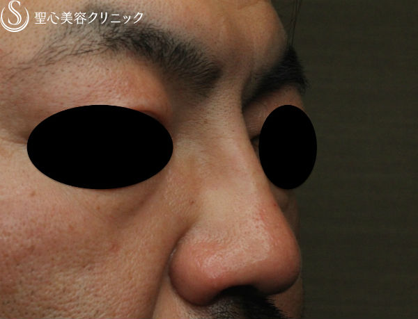 【40代男性・最新の長期持続型ヒアルロン酸で鼻根部を高く】クレヴィエル・コントア（注入直後） After 