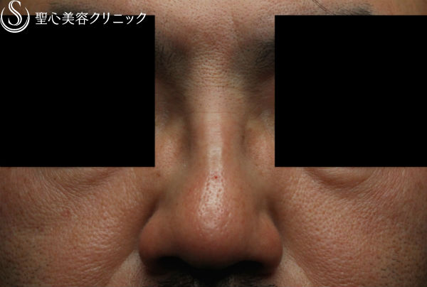 【40代男性・最新の長期持続型ヒアルロン酸で鼻根部を高く】クレヴィエル・コントア（注入直後） After 