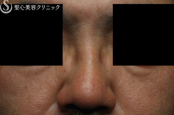 【40代男性・最新の長期持続型ヒアルロン酸で鼻根部を高く】クレヴィエル・コントア（注入直後） Before 