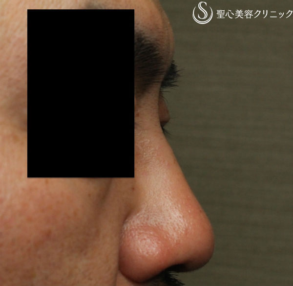 【40代男性・最新の長期持続型ヒアルロン酸で鼻根部を高く】クレヴィエル・コントア（注入直後） Before 