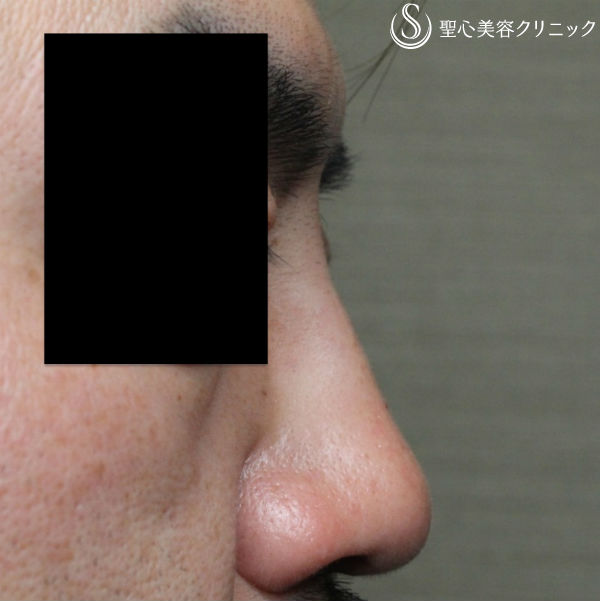 【40代男性・最新の長期持続型ヒアルロン酸で鼻根部を高く】クレヴィエル・コントア（注入直後） After 