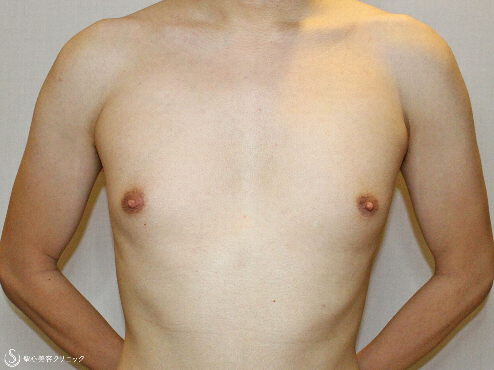 【20代男性・真性女性化乳房】乳腺切除+ベイザー脂肪吸引（4ヶ月後） Before 