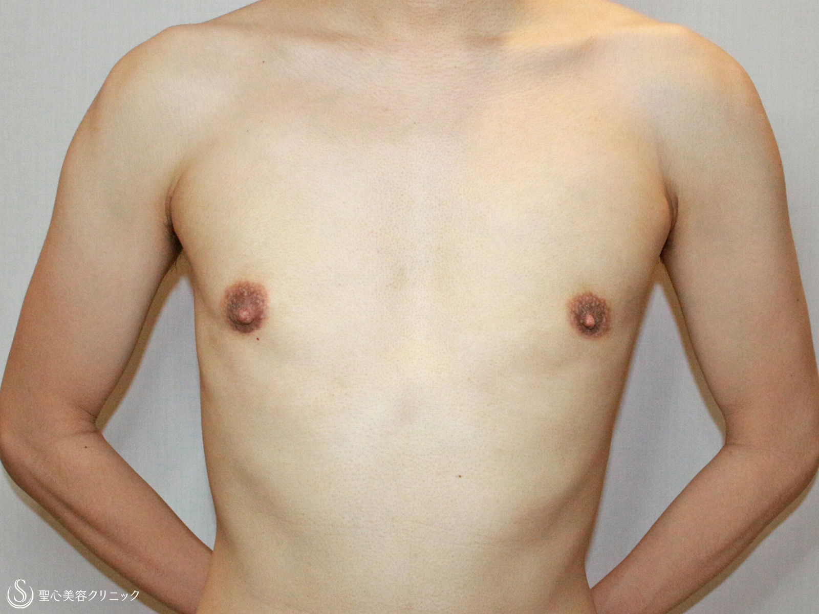 【20代男性・真性女性化乳房】乳腺切除+ベイザー脂肪吸引（4ヶ月後） After 