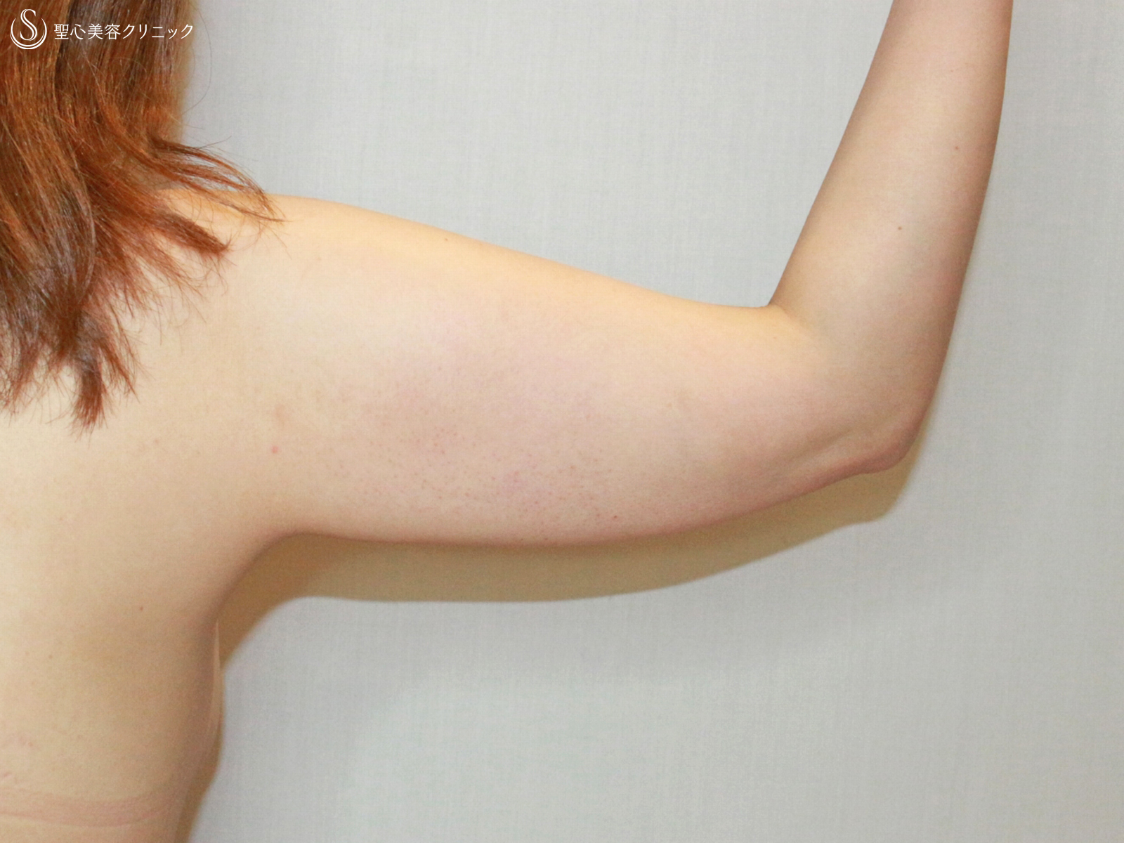 【40代女性・二の腕を細く】ベイザー脂肪吸引（4.5ヶ月後） 症例写真 美容整形、美容外科なら聖心美容クリニック