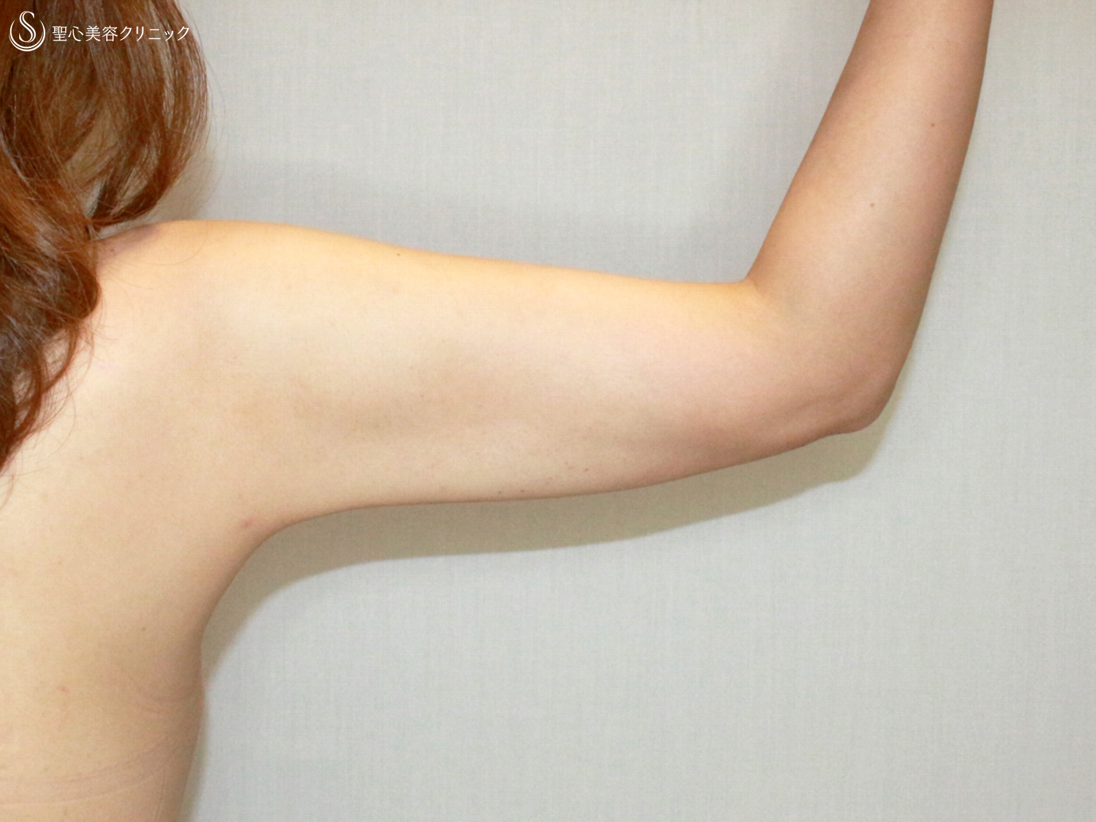 【40代女性・二の腕を細く】ベイザー脂肪吸引（4.5ヶ月後） 症例写真 美容整形、美容外科なら聖心美容クリニック