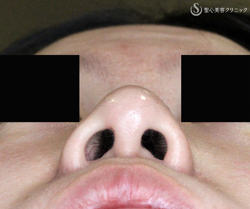 【20代女性・左右差のある団子鼻+しし鼻】二つの+α法で治療（術後2年）札幌院 Before 