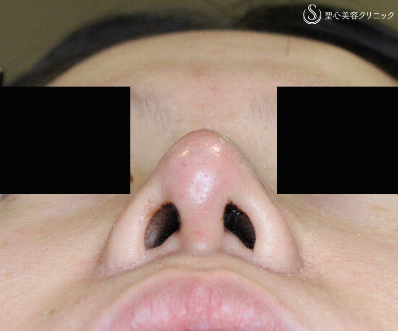 【20代女性・左右差のある団子鼻+しし鼻】二つの+α法で治療（術後2年）札幌院 After 