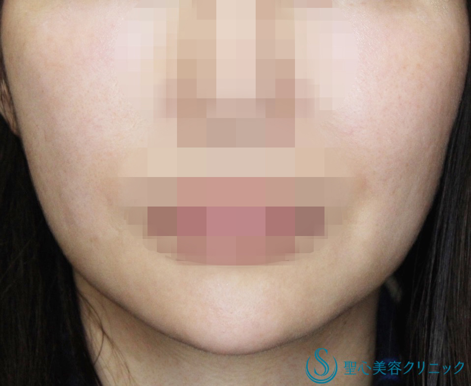 【30代女性・スッキリ小顔に、人気のメソセラピー】輪郭注射（5回処置後） After 