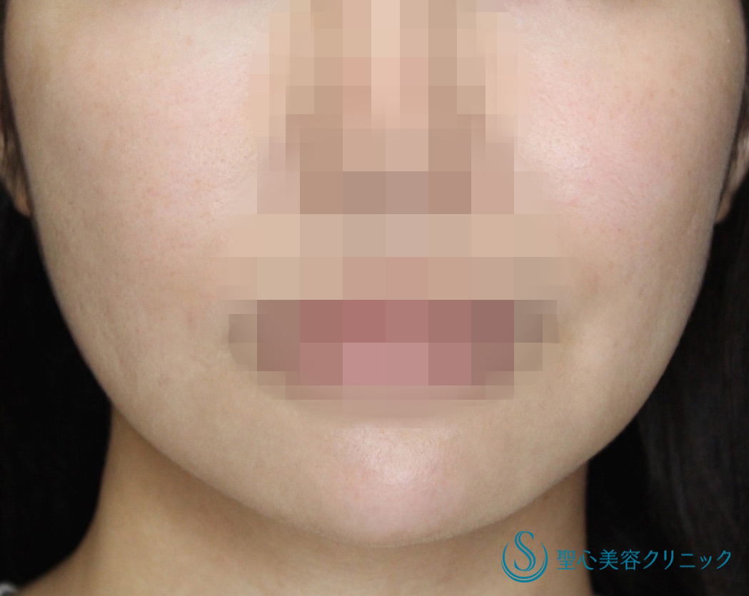 【30代女性・スッキリ小顔に、人気のメソセラピー】輪郭注射（5回処置後） Before 