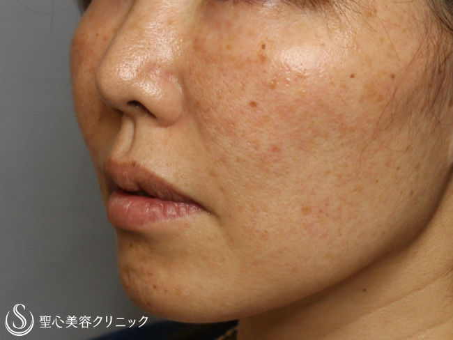 【40代女性・くすみ毛穴改善】ライムライト（3回処置後） Before 