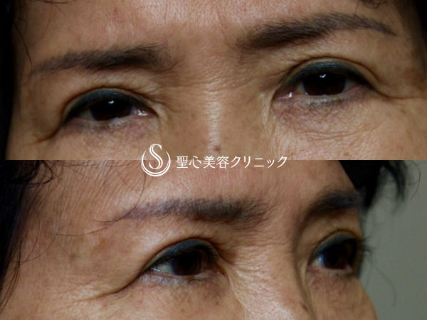 【70代女性・上まぶたのたるみをスッキリと】眉下切開 After 