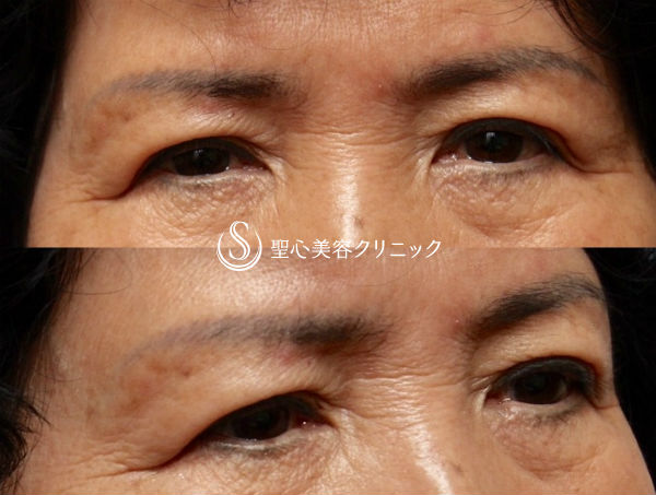 【70代女性・上まぶたのたるみをスッキリと】眉下切開 Before 