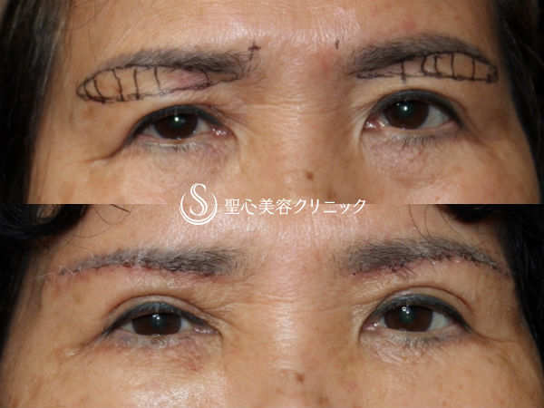 【70代女性・上まぶたのたるみをスッキリと】眉下切開 After 