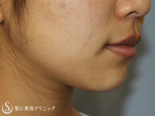 【20代女性・フェイスライン】ベイザー脂肪吸引（アゴ下） Before 