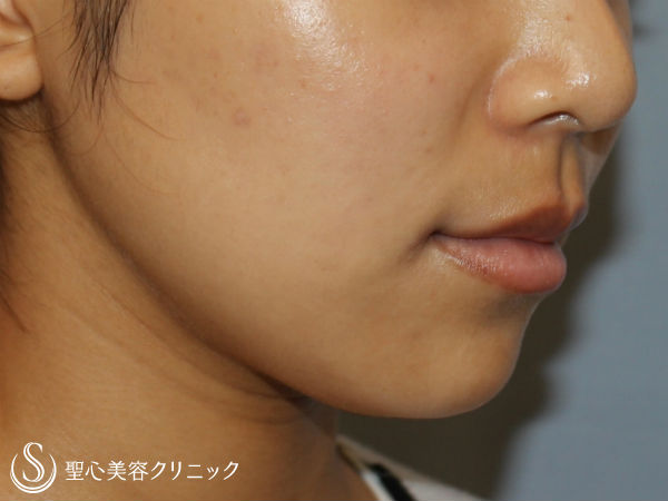 【20代女性・フェイスライン】ベイザー脂肪吸引（アゴ下） After 