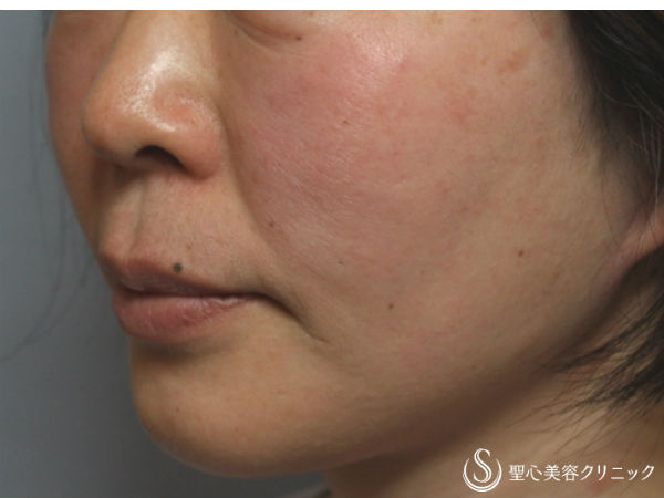 【50前後女性・4回目の治療】ドクターハイフ（ウルセラシステム）治療（1ヶ月後） Before 