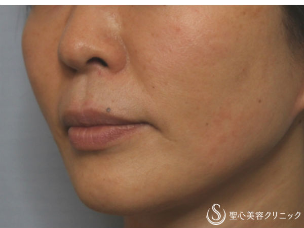 【50前後女性・4回目の治療】ドクターハイフ（ウルセラシステム）治療（1ヶ月後） After 