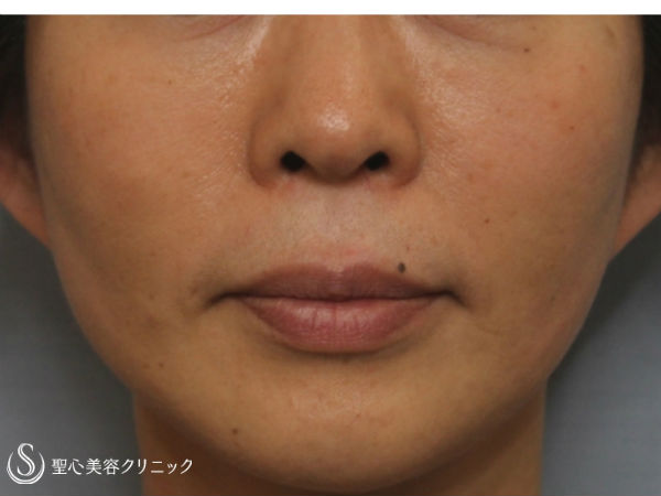 【50前後女性・4回目の治療】ドクターハイフ（ウルセラシステム）治療（1ヶ月後） After 