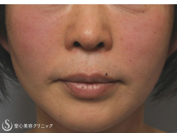 【50前後女性・4回目の治療】ドクターハイフ（ウルセラシステム）治療（1ヶ月後） Before 