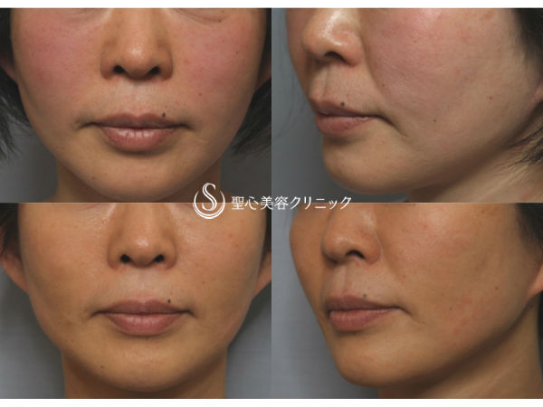 【50前後女性・4回目の治療】ドクターハイフ（ウルセラシステム）治療（1ヶ月後） After 