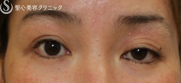 30代女性 左右差の改善 左眼瞼下垂修正 埋没法 症例写真 美容整形 美容外科なら聖心美容クリニック 30代女性 左右差の改善 左眼瞼下垂修正 埋没法 症例写真 美容整形 美容外科なら聖心美容クリニック