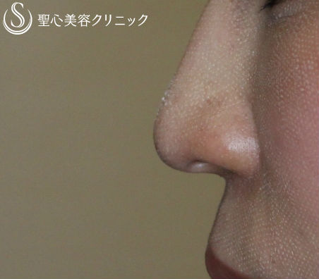 【30代女性・鼻先をスッキリと】鼻先修正（術後１ヶ月） Before 
