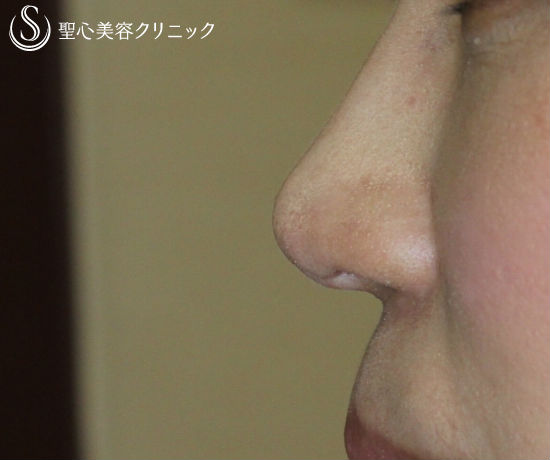 【30代女性・鼻先をスッキリと】鼻先修正（術後１ヶ月） After 