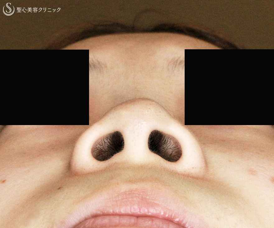 【20代女性・正面から鼻の穴が見える】小鼻縮小術+α法＆鼻プロテーゼ（5年後） Before 