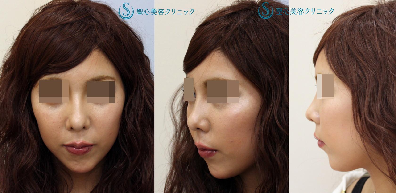 【20代女性・上向きの鼻を治してＥラインを整えたい】鼻尖～鼻柱耳介軟骨移植（1ヶ月後） After 