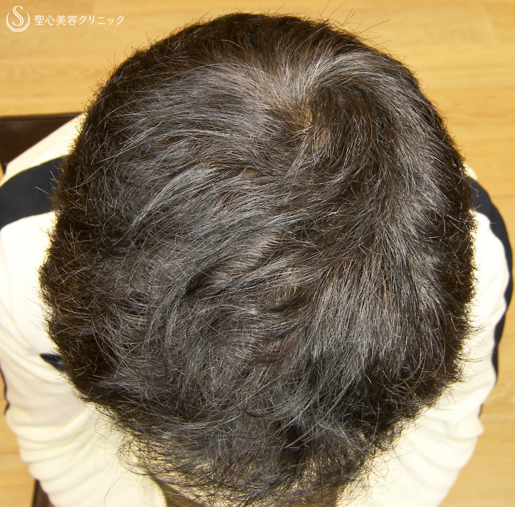 【50代男性・AGA男性型脱毛】グロースファクター毛髪再生療法（8回後） After 