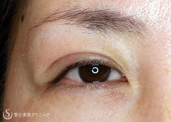 【30代女性・他院埋没法後の抜糸と再手術】マイクロメソッド+α法（1年後） Before 