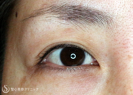 【30代女性・他院埋没法後の抜糸と再手術】マイクロメソッド+α法（1年後） After 