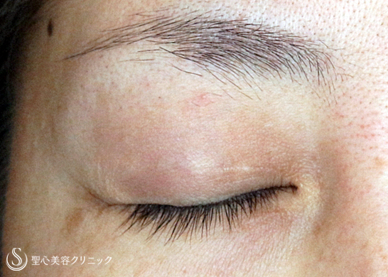 【30代女性・他院埋没法後の抜糸と再手術】マイクロメソッド+α法（1年後） After 