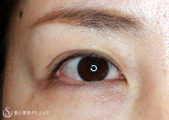 【30代女性・他院埋没法後の抜糸と再手術】マイクロメソッド+α法（1年後） After 