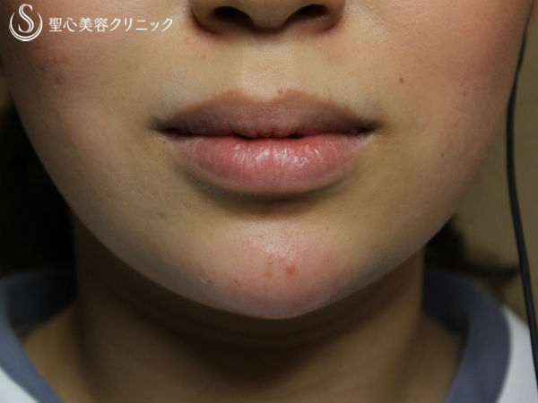 【女性】アゴのクレヴィエル（ヒアルロン酸）注入直後 After 