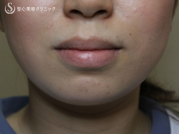 【女性】アゴのクレヴィエル（ヒアルロン酸）注入直後 Before 