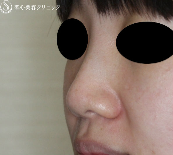 【30代女性・鼻筋を高く】ヒアルロン酸（クレヴィエル・コントア）注入直後 Before 