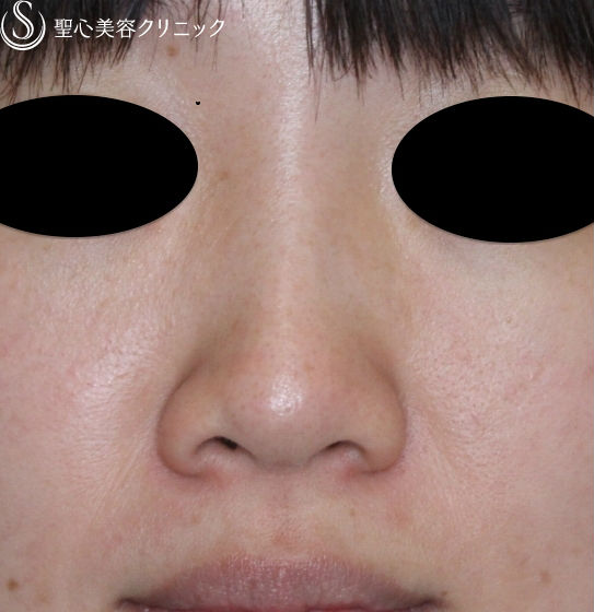 【30代女性・鼻筋を高く】ヒアルロン酸（クレヴィエル・コントア）注入直後 Before 