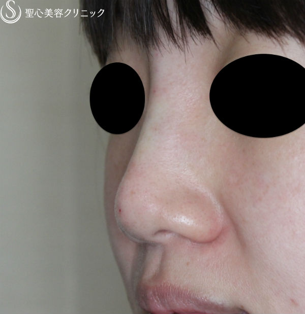 【30代女性・鼻筋を高く】ヒアルロン酸（クレヴィエル・コントア）注入直後 After 