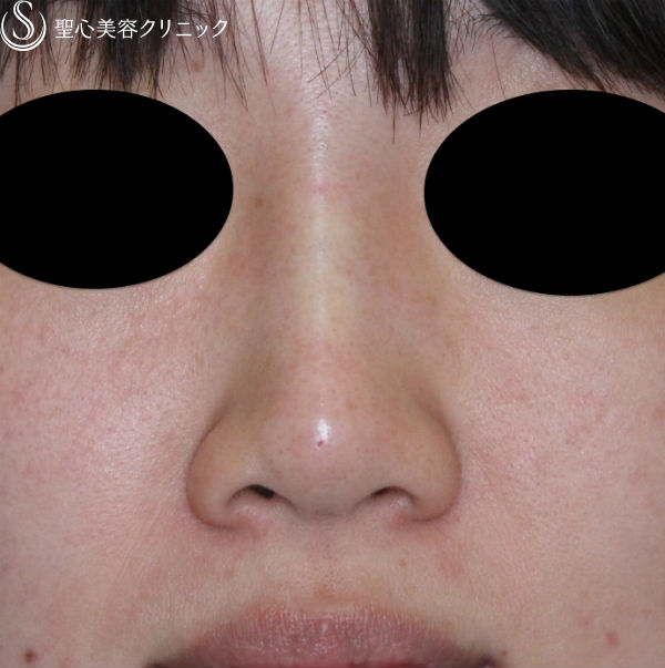 【30代女性・鼻筋を高く】ヒアルロン酸（クレヴィエル・コントア）注入直後 After 