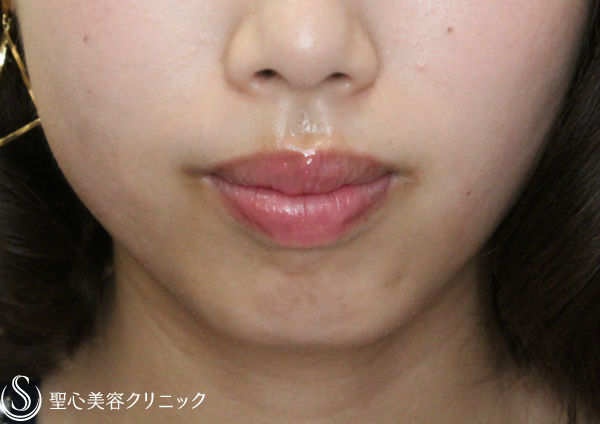 【20代女性・ヒアルロン酸で小顔に】クレヴィエル・コントア注入 Before 